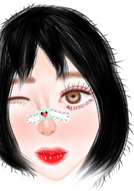 Korean girl after rhinoplastie