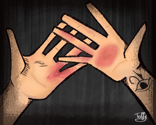 Psoriasis