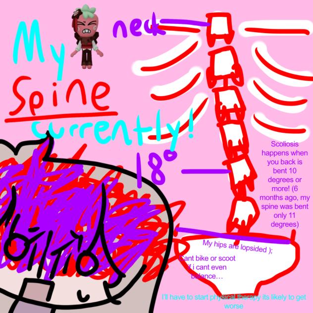 Scoliosis…