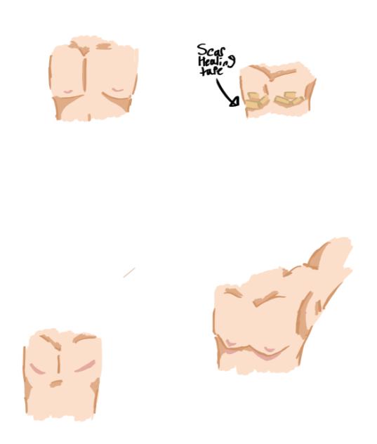 Top surgery scars!!