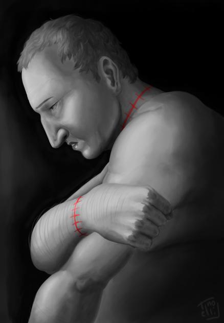 Scars